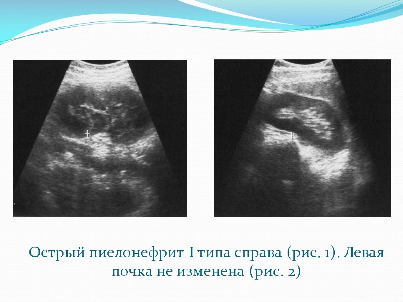 Острый пиелонефрит I типа справа (рис. 1). Левая почка не изменена (рис. 2)